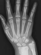 Image result for Bone Age Hand X-ray