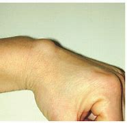 Image result for Volar Wrist Cyst