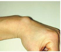 Image result for Cyst On Wrist