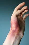 Image result for Blood Bruise Aesthetic