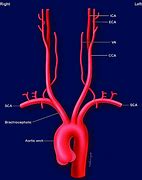 Image result for 3 Branches of Aortic Arch