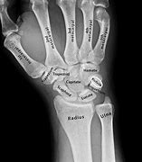 Image result for Carpal Angle