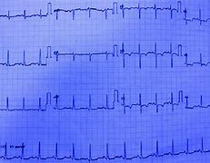 Image result for RVH ECG