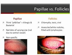 Image result for Conjunctival Papillae