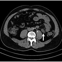 Image result for Long Tunnel Ureter