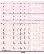 Image result for Atrial Fibrillation 12 Lead ECG