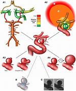 Image result for Unruptured Aneurysm