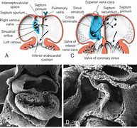 Image result for Septum Secundum