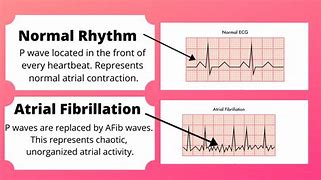 Image result for AFib vs V-fib