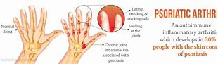 Image result for Psoriatic Arthritis