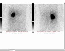 Image result for MIBG Pheochromocytoma