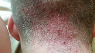 Image result for Bacterial Folliculitis Scalp