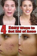 Image result for How to Get Rid Acne Bumps