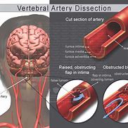 Image result for Vertebral Dissection On Angiogram