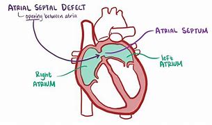 Image result for Atrioventricular Canal Defect Osmosis