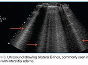 Image result for Lung Ultrasound B Lines Pulmonary Edema