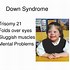 Image result for Klinefelter's Syndrome