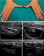 Image result for First Dorsal Interosseous Atrophy