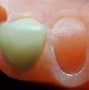 Image result for CAD/CAM Dentures