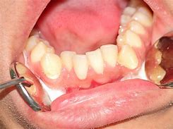 Image result for Mouth Bite