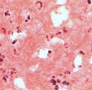 Image result for Mycobacterium GM's Stain