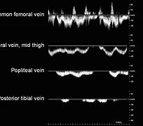 Image result for Nonphasic Venous Flow