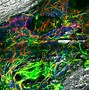 Image result for DDR and Bone Metastasis