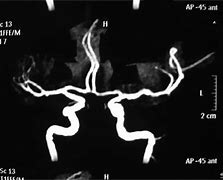 Image result for Brain MRI Angiogram