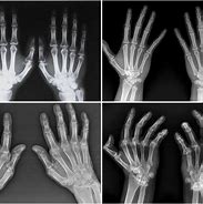 Image result for Normal Hand Radiograph