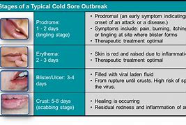 Image result for Cold Sores Symptoms