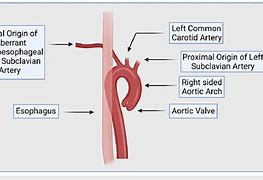 Image result for Retrocaval Artery