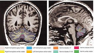 Image result for Cerebellar Vermis MRI