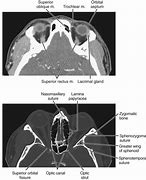 Image result for Orbital Bone Anatomy Model