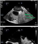 Image result for Right Atrial Appendage Thrombus