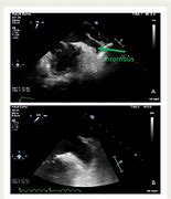 Image result for Left Atrial Appendage Thrombus On Toe