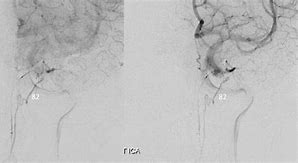 Image result for Dorsal Nasal Artery