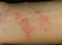 Image result for Poison Ivy Rash African American