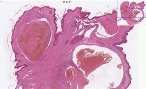 Image result for Thrombosis Histology