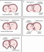 Image result for Interatrial Septum Formation