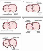 Image result for Septum Secundum