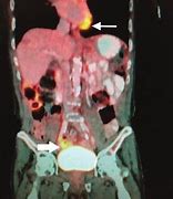 Image result for Pet Scan Glucose