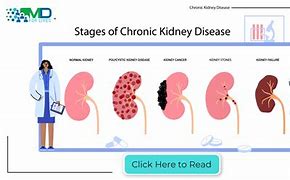 Image result for Chronic Kidney Disease