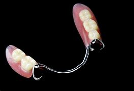 Image result for Partial Denture Clasps