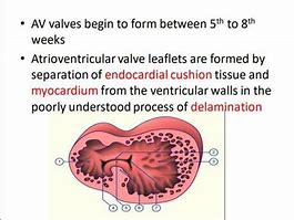 Image result for Atrioventricular Canal Defect Osmosis