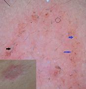 Image result for Filiform Wart On Finger