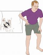 Image result for Ilioinguinal Nerve Pain