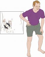 Image result for Ilioinguinal Nerve Pain Syndrome