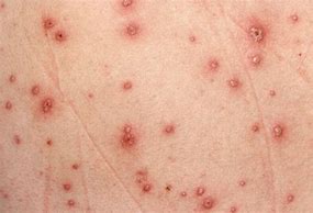 Image result for Red Flat Skin Lesion