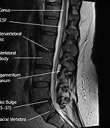 Image result for Piriformis Sciatica