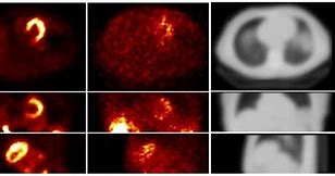 Image result for SPECT Cardiaco